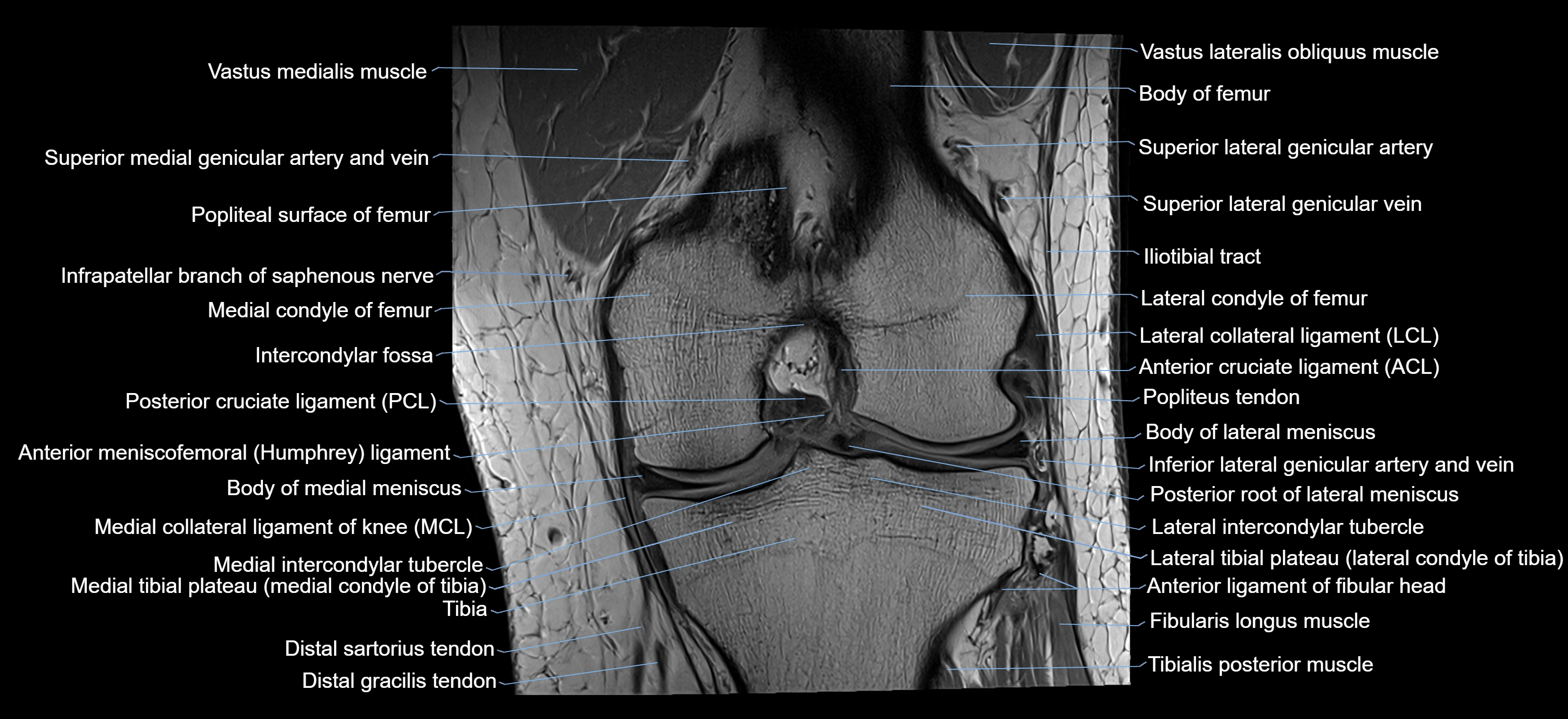 MRI knee coronal cross sectional anatomy labelled 3T radiology  image-04001-00023.webp